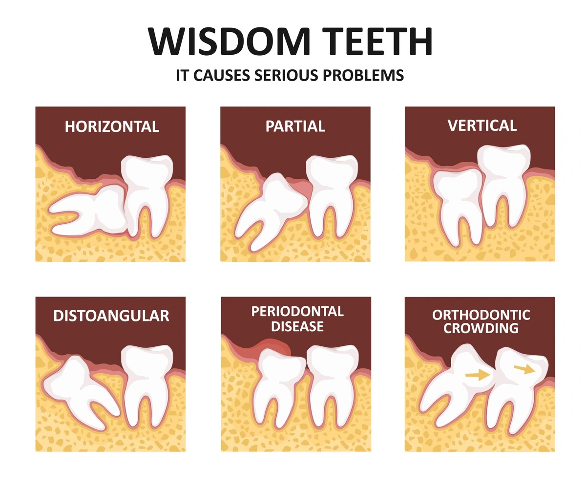 types of impacted wisdom teeth