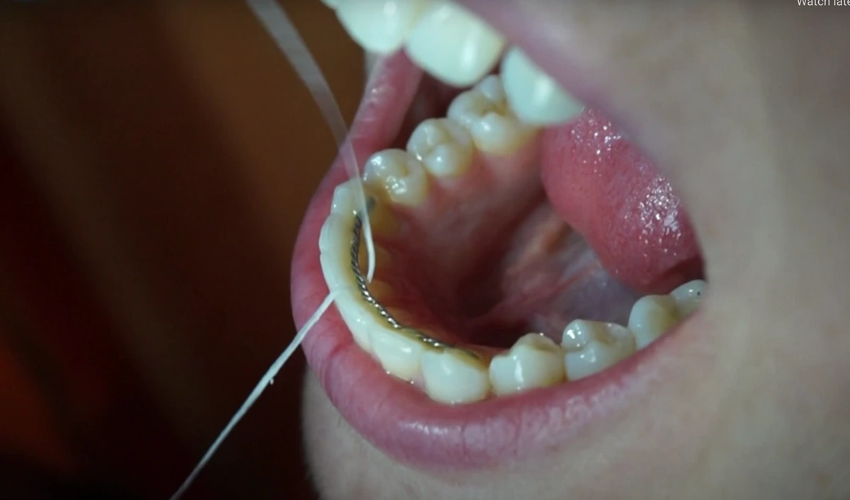 How to use Superfloss with fixed braces. 