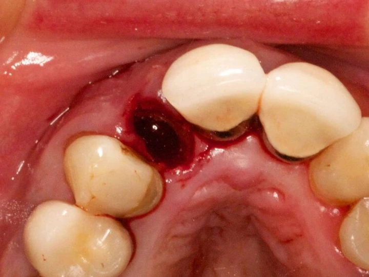 What Does Dry Socket Look Like Compared to a Blood Clot?