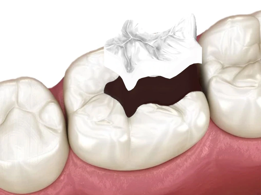 How Much Do Dental Fillings Cost  