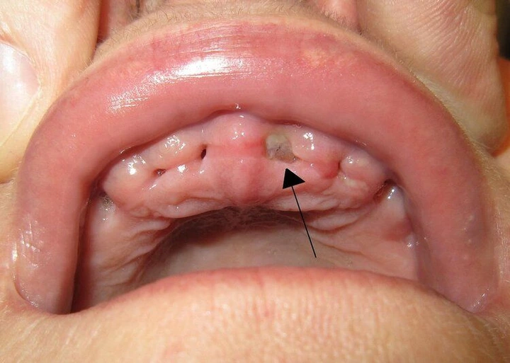 dry socket vs blood clot