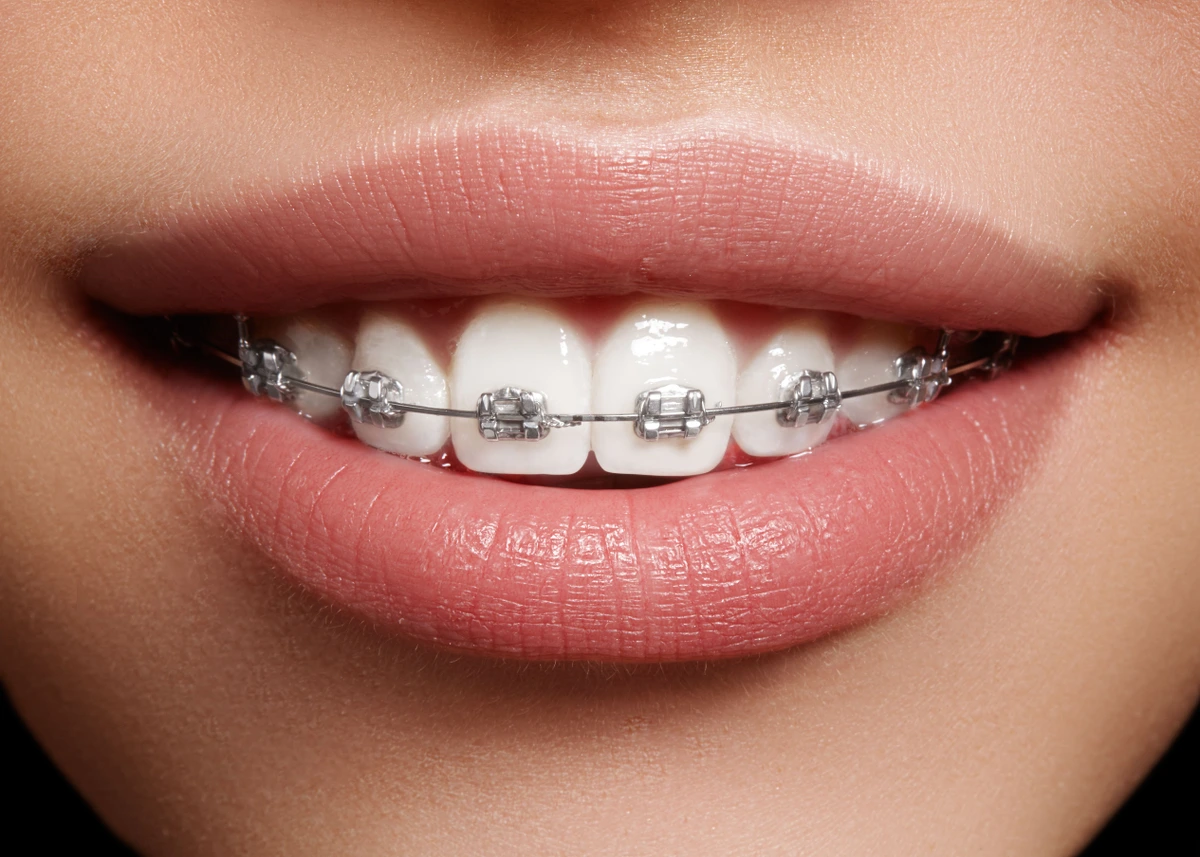 Price range and payment options for braces