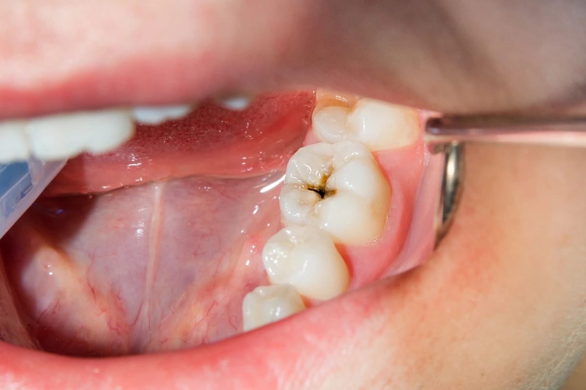 Can Teeth Repair Itself?