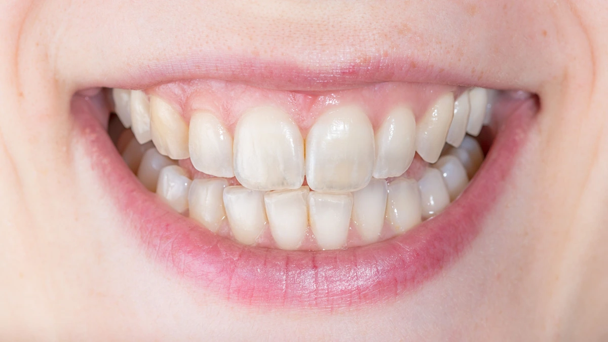 Thinning Enamel? How to Spot Enamel Loss & Damage