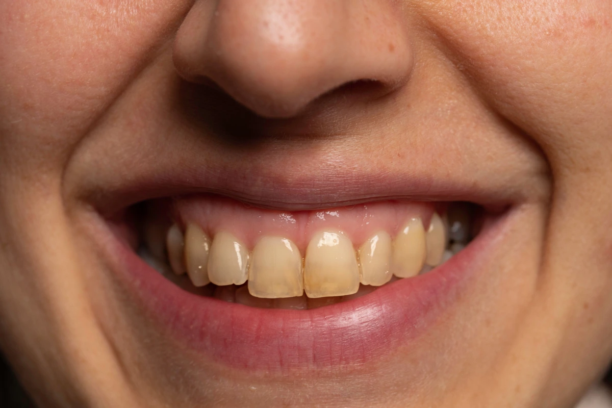 15 Ways to Get Perfect White Teeth | The Secret to White Teeth