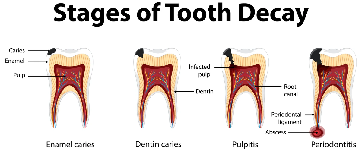 7 Ways To Make Novocaine Numbness Go Away After Dentist