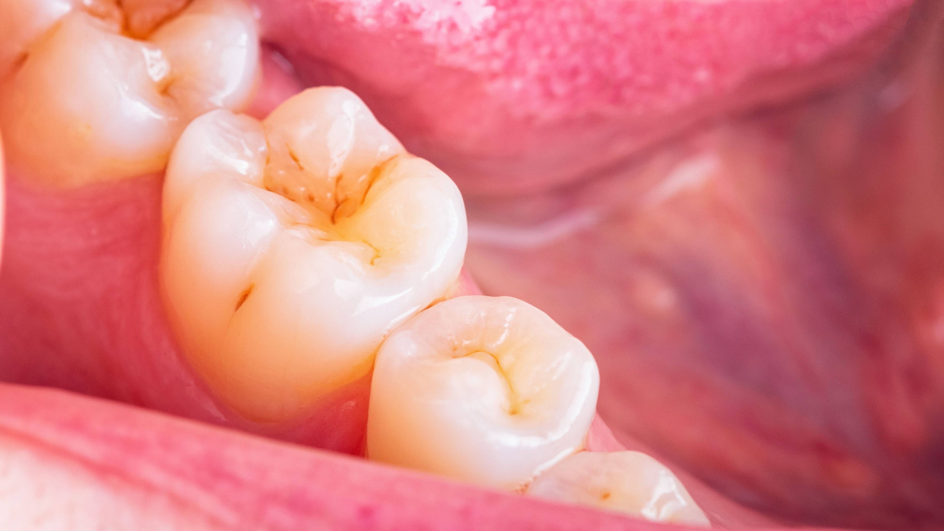 early stage cavities on molars 