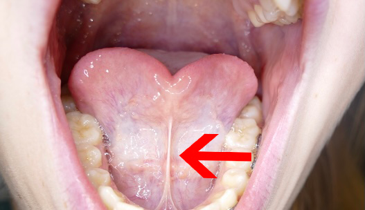 lingual frenulum sore