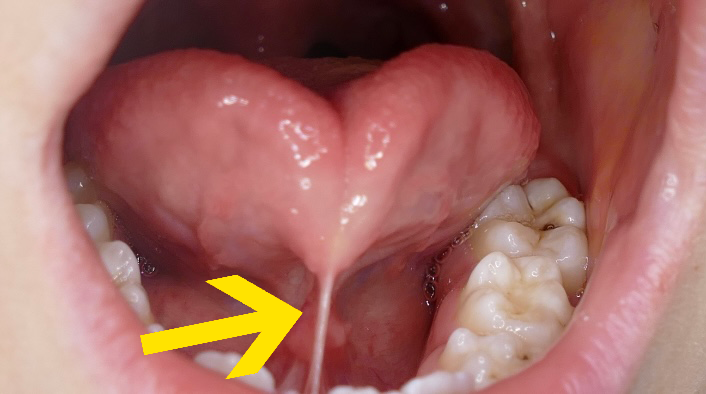 lingual frenulum sore