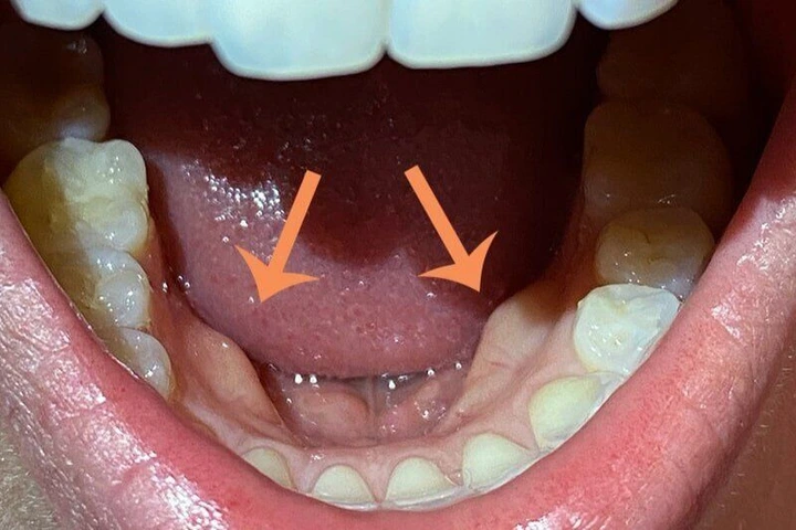 Large Tori In Mouth Pictures Of Mandibular Tori OAPHT Large Tori In Mouth Pictures Of Mandibular Tori OAPHT