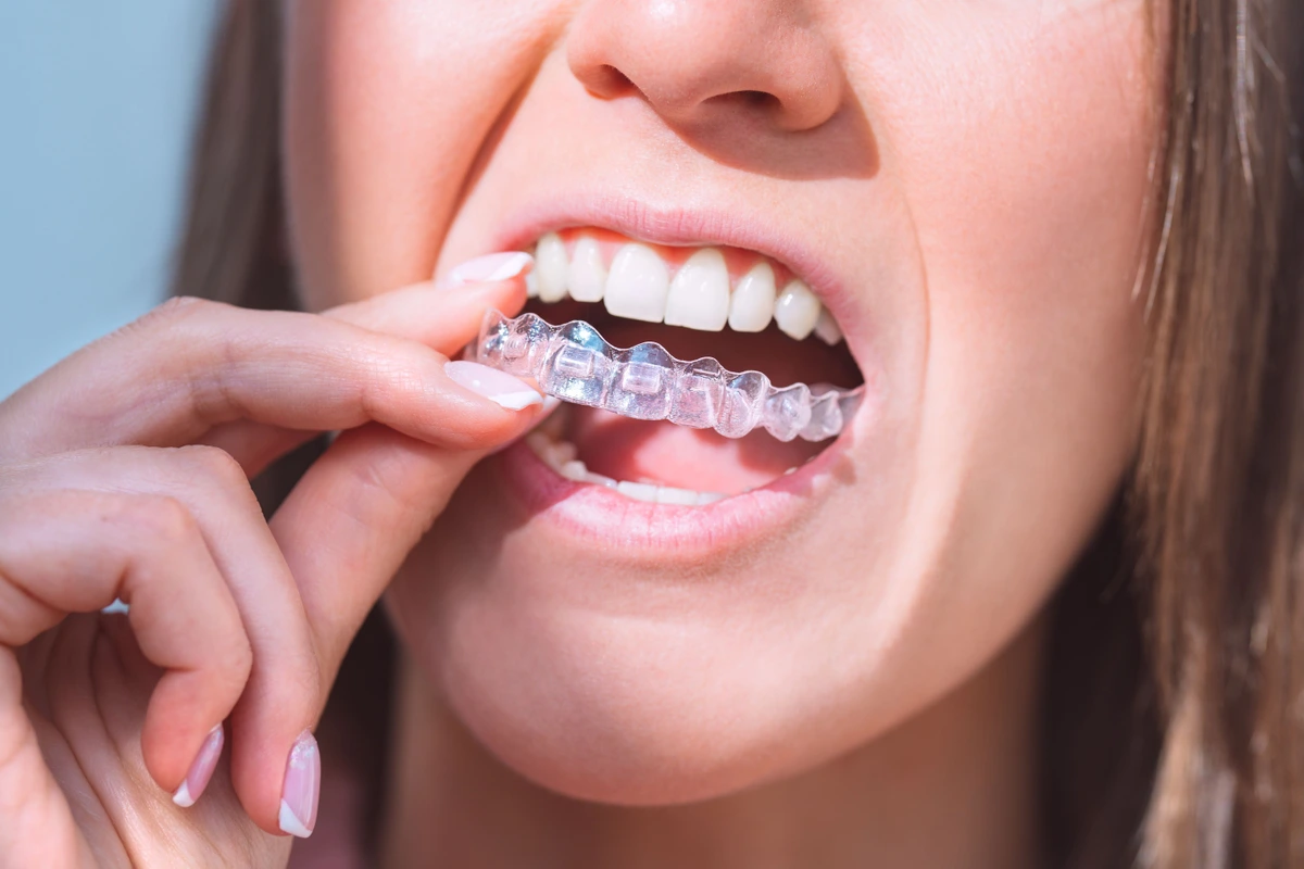 How Much Does Invisalign Cost? With & Without Insurance