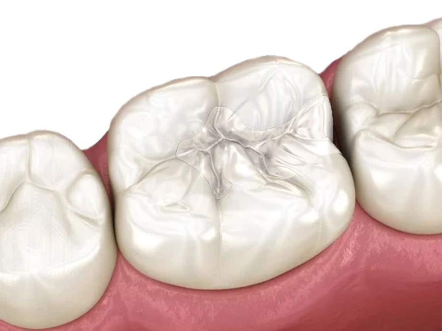 Fillings - Back 2 Basics Dentistry