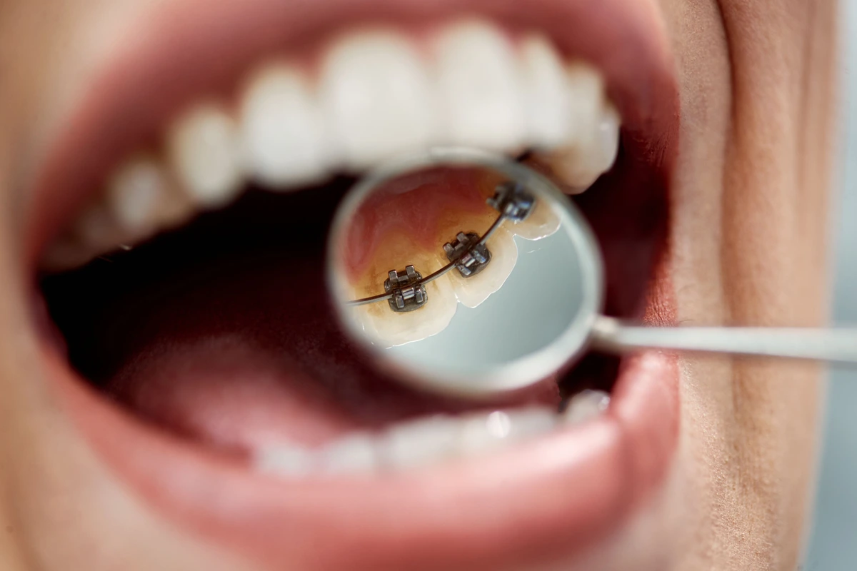 How Much Do Braces Cost Without Insurance?