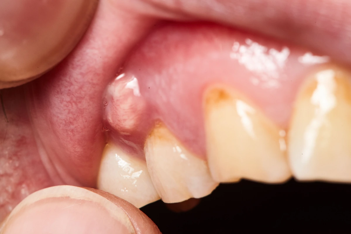 How do you Know if you have a Rotten Tooth?