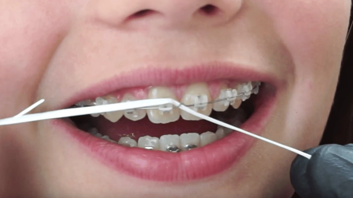 7 Things To Know About Lingual Braces: Pros, Cons & Cost