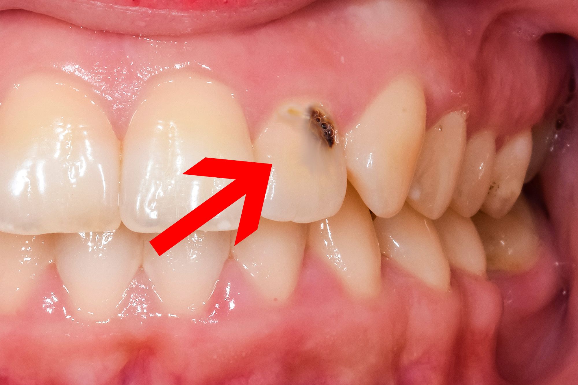 What Do Cavities Look Like Before The Treatment 