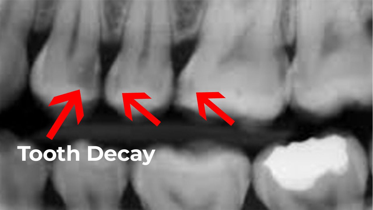 tooth decay on dental xrays