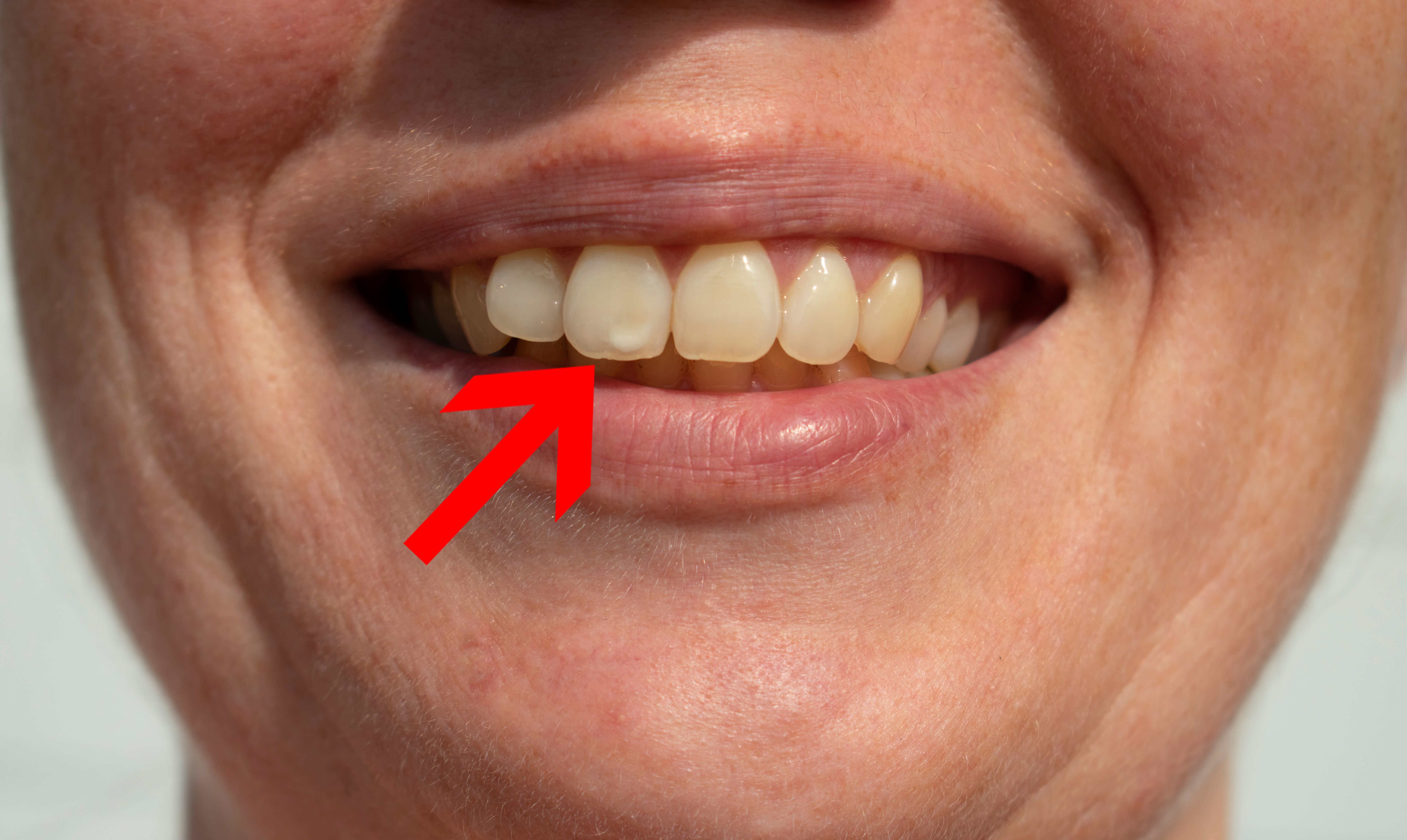 cavities between front teeth